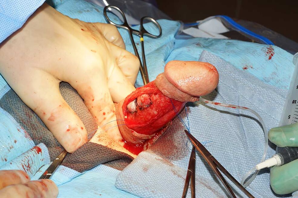 Penis lengthening surgery