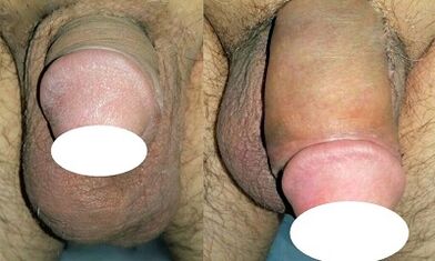 Photo before and after increasing penis